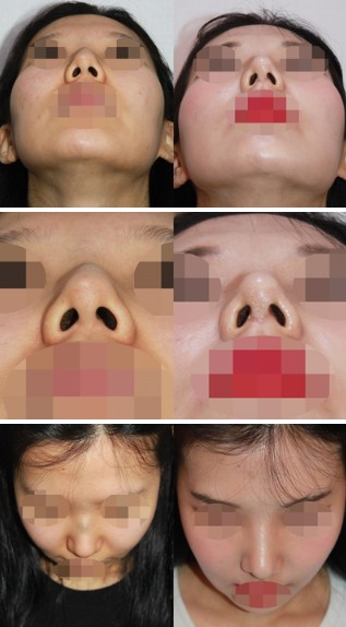 รีวิวทำจมูกที่เกาหลีกับคุณหมอยูน